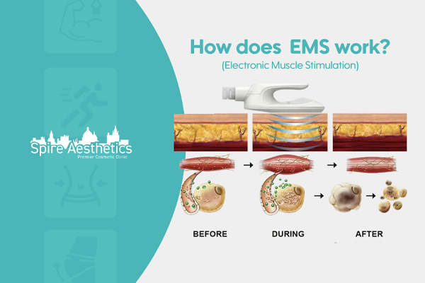 EMS treatment for post pregnancy weight loss treatment Binton
