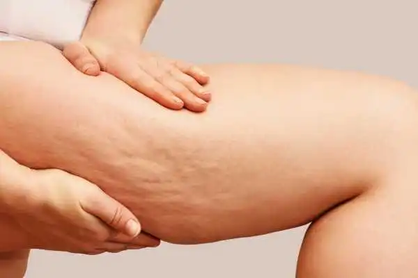 Image of woman showing leg with cellulite Binton