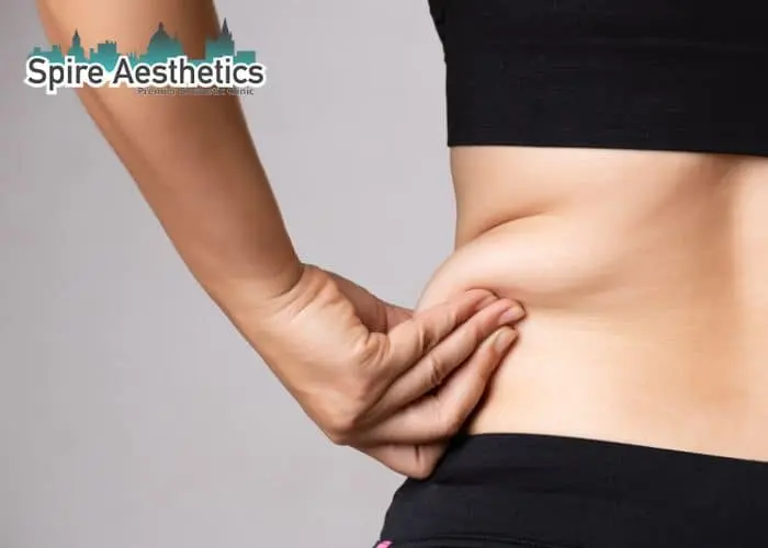 Image of woman pinching fat on their hips Binton. Fat Freezing treatment 