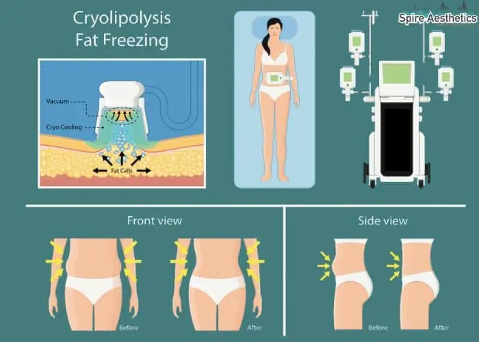Fat freezing treatment Binton benefits for competitions to remove stubborn fat deposits.