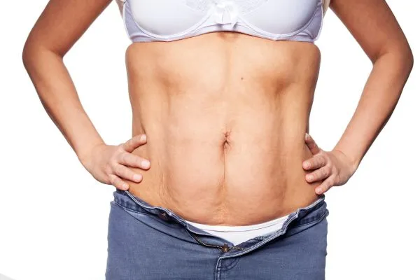 sagging skin on woman's stomach after weight loss injections Binton