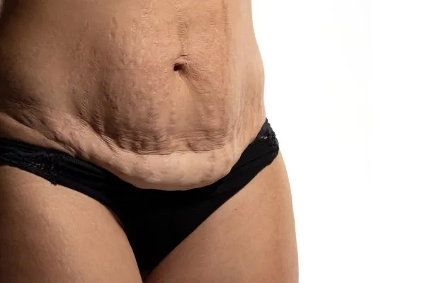 Image of womans stomach after weight loss injections Binton showing saggy skin