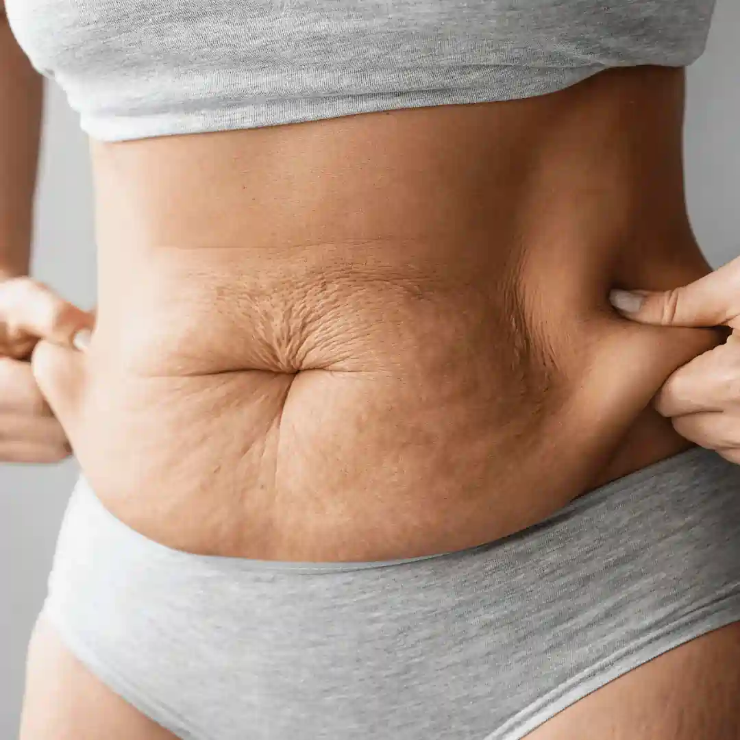 Is It Normal to Have Loose Skin After Pregnancy Binton?