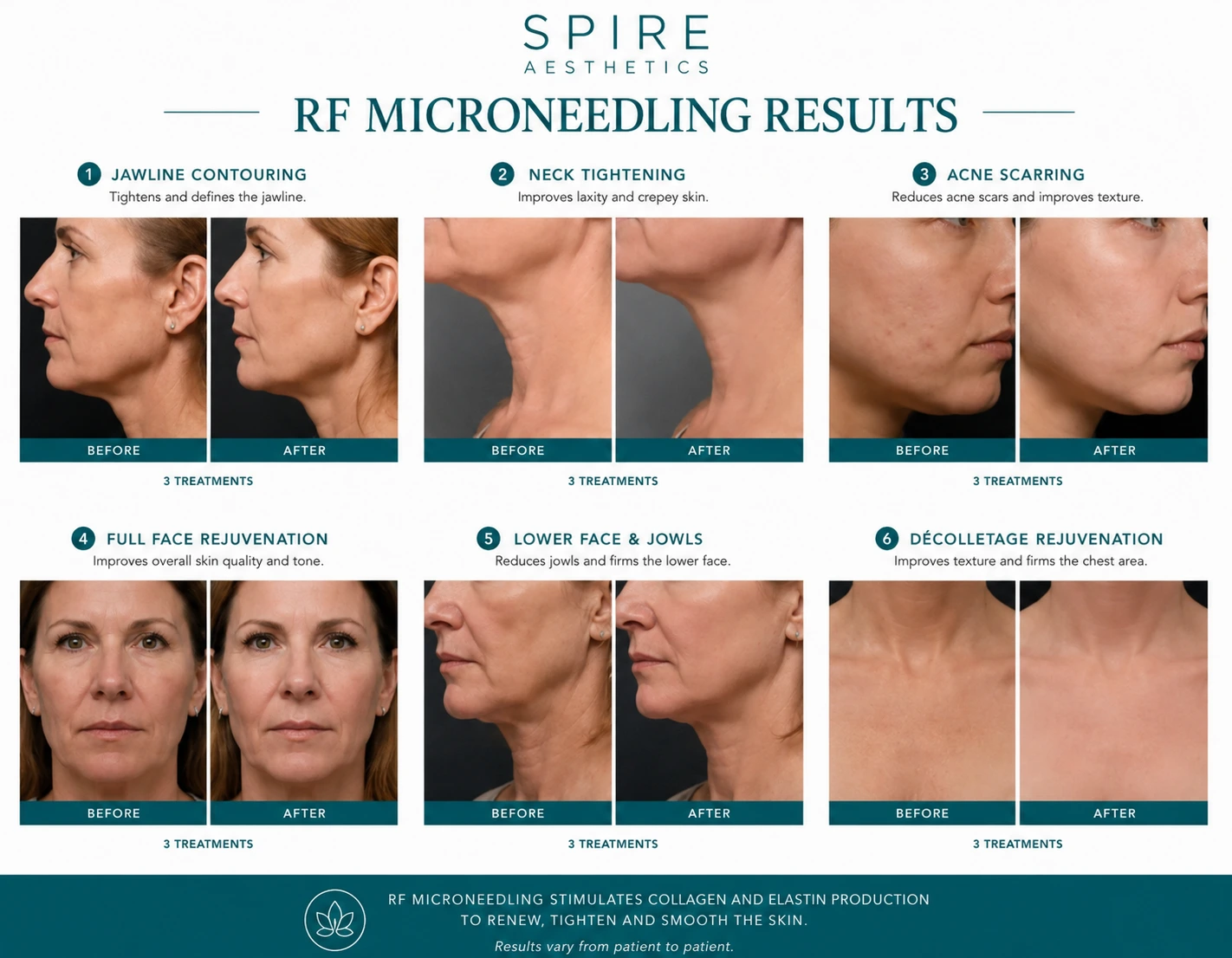 RF Microneedling Skin tightening Binton results